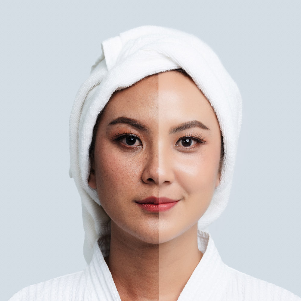 The Complete Guide to Understanding and Treating Hyperpigmentation Naturally